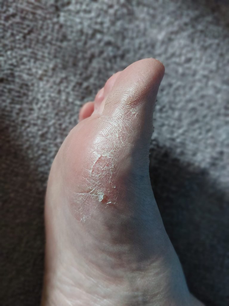 voetschimmel uit schoenen verwijderen hoe doe je dat? Een behandeling tegen schimmel en een schoenverfrisser van shoefresh