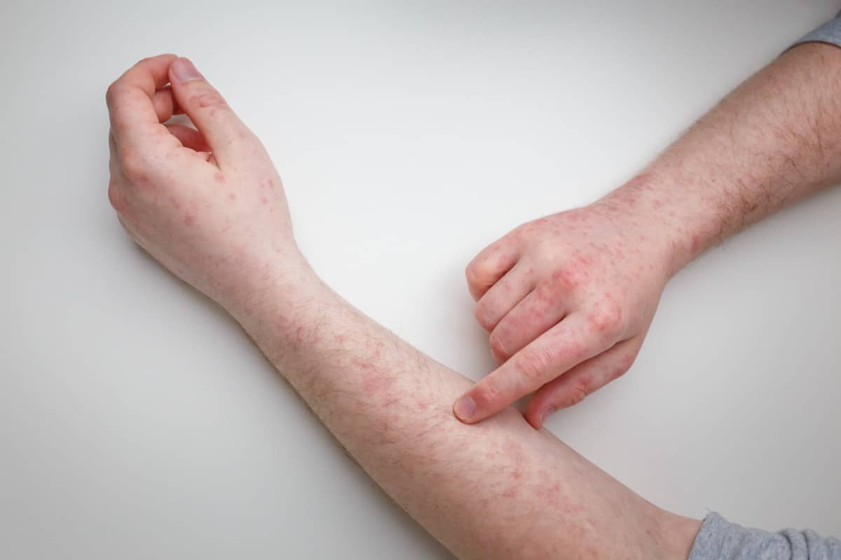 schurft soorten huidschimmel schimmelinfectie